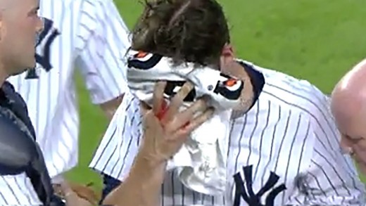 Yankees Pitcher Bryan Mitchell Takes Line Drive To The Face